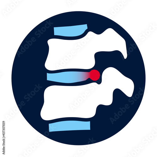intervertebral hernia concept