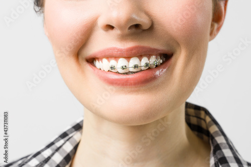 Orthodontic Treatment. Dental Care Concept. Beautiful Woman Healthy Smile close up. Closeup Ceramic and Metal Brackets on Teeth. Beautiful Female Smile with Braces.