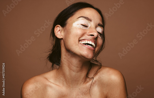 Obraz na plátně Happy woman with skin condition