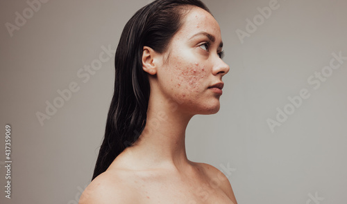 Stress and depression due to skin problems photo