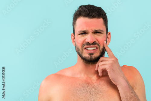 Young shirtless man with sunburn looking at camera isolated on blue