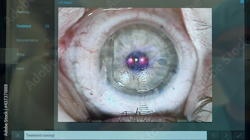 Close up of patient's eye during laser correction photo