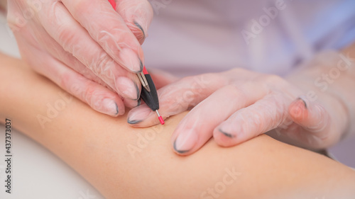 The doctor makes electro epilation of the woman s hands in the salon. Close-up of hardware removal of unwanted hair forever