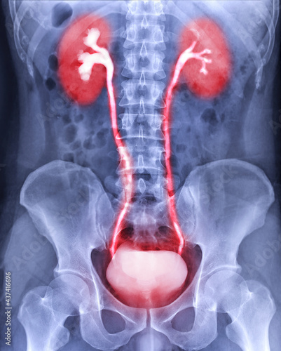Intravenous pyelogram or I.V.P showing  of urinary tract after injection contrast media agent 25 minute. photo