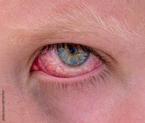 Close up of a boy's red eyes.