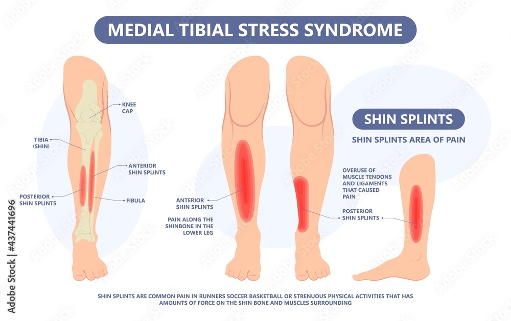Shin splint leg pain knee injury Sport Lower tibia strain tendon