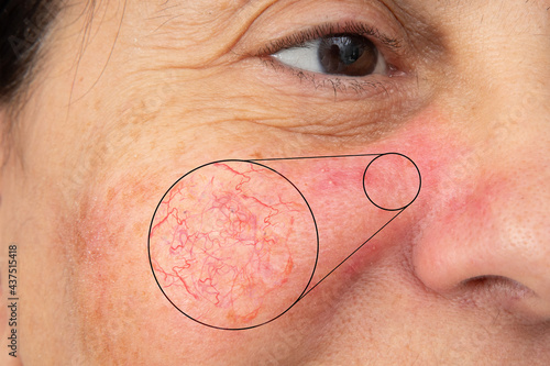 Schilderij op canvas Woman's face showing redness due to fragile capillaries