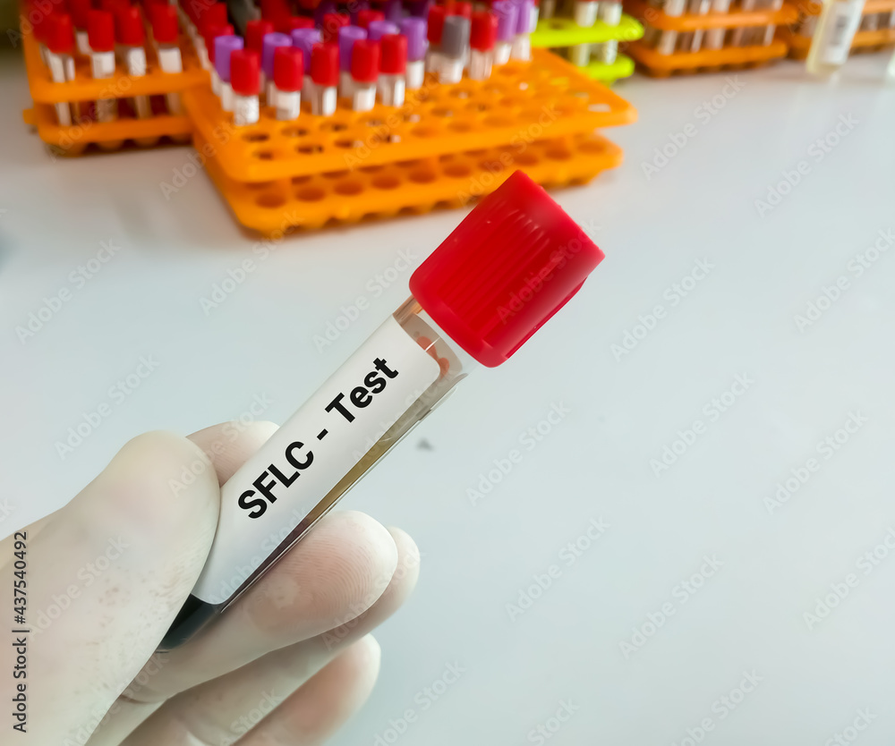 Blood sample for Serum Free Light Chain test. diagnosis for plasma cell
