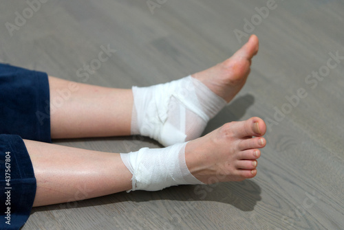 callus on leg. Girl uses ointment, Band-Aid and bandage to treat calluse. foot treatment © valeri