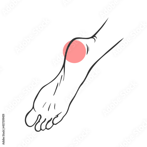 Leg with heel pain. Orthopedic disease plantar fasciitis. Vector isolated outline illustration