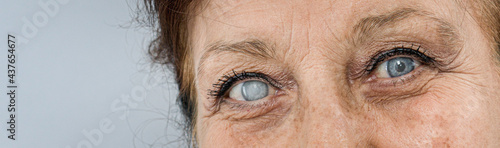 old woman  sick eye detail