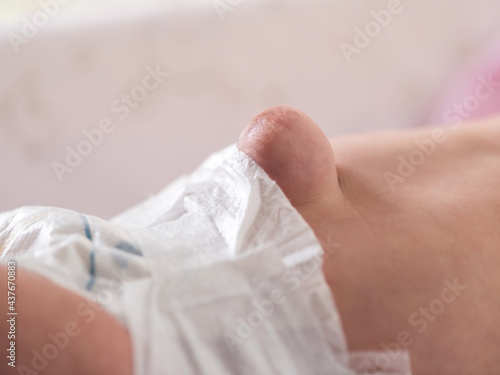 Large umbilical hernia in premature neborn baby