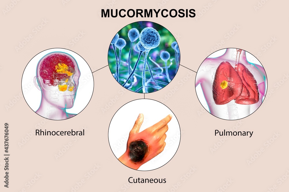 Clinical Forms Of Mucormycosis A Disease Caused By Mucor Fungi Also Known As Black Fungus