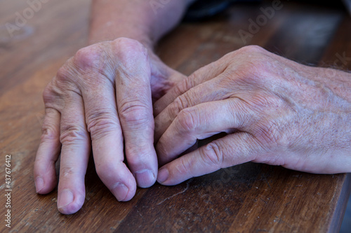 The hands of a man with psoriatic arthritis on a wooden table. photo