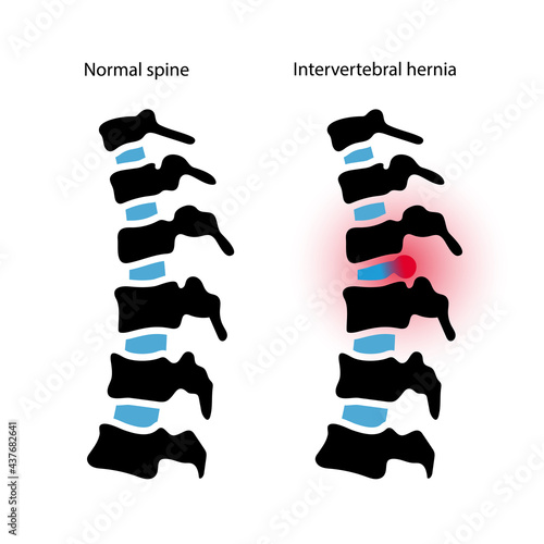 intervertebral hernia concept