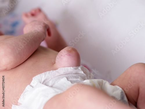 Large umbilical hernia in premature newborn baby