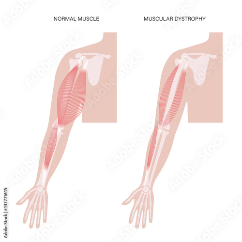 Muscular dystrophy of arm