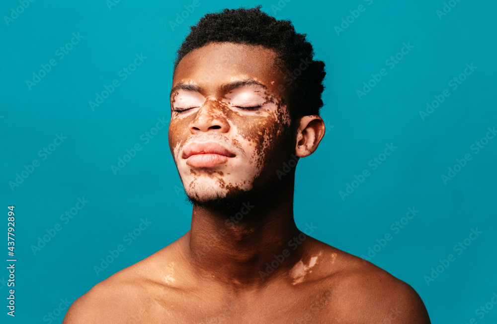 Portrait of a Black man with vitiligo Portrait of a Black man with vitiligo
