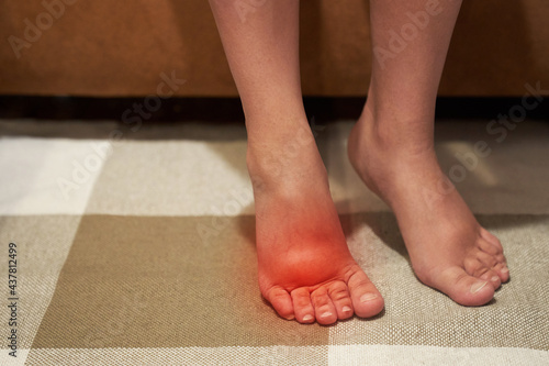 Canvas-taulu Woman with swelling on the legs, tired and pain in the legs, swelling during pregnancy