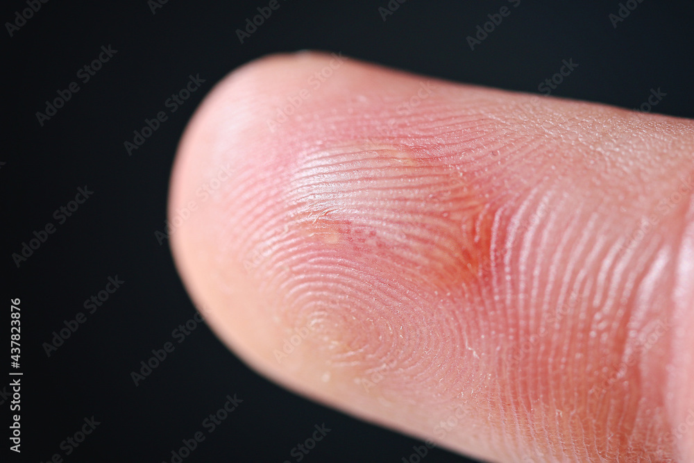 Callus on the middle finger of a man's hand Callus on the middle finger of a man's hand