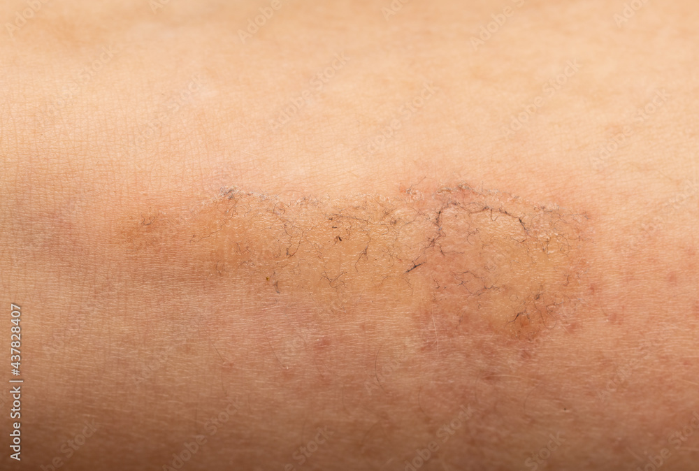 Fototapeta premium dirty scratch on the skin as background