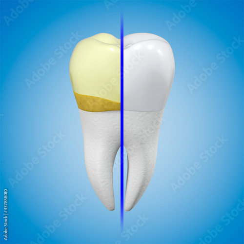 The concept of professional tooth cleaning. A tooth with yellow plaque and calculus and a white tooth with shiny enamel in comparison. 3d rendering.