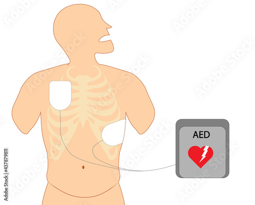 Defibrilator electrode position. Electrode chest position to defibilator shock.