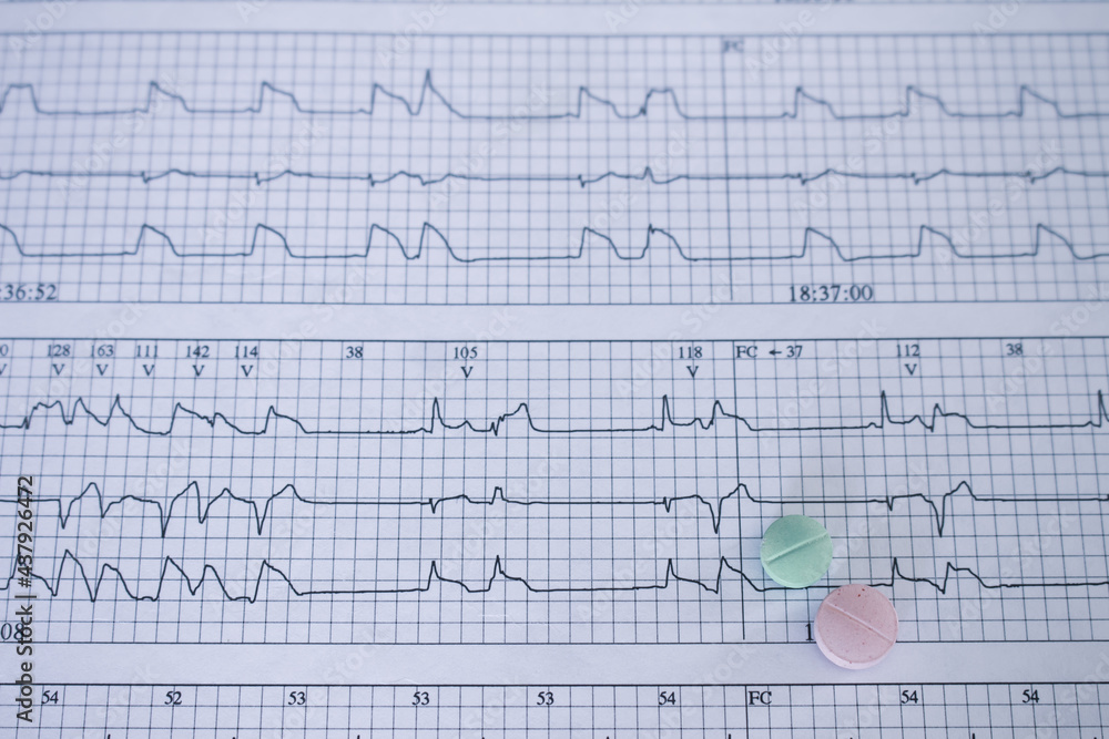 Medications for the heart on electrocardiograms with arrhythmias. Post covid cardiovascular disease concept. Medications for the heart on electrocardiograms with arrhythmias. Post covid cardiovascular disease concept.