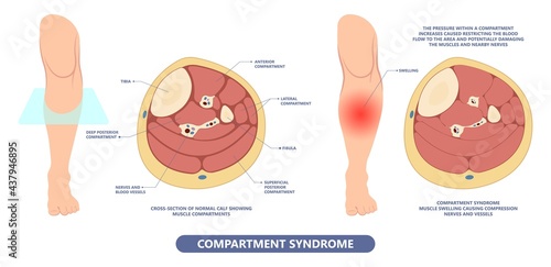 Shin splint leg pain knee injury Sport Lower tibia strain tendon muscle fall impact trauma bone joint runner painful crack small tiny fibula Soccer limb acute crush Deep vein blood clot kneecap ache photo