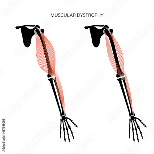 Muscular dystrophy of arm