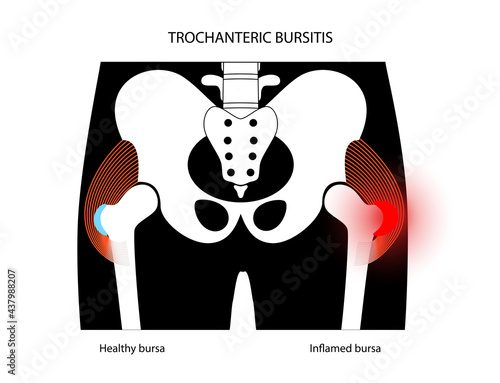 Bursitis inflammation concept