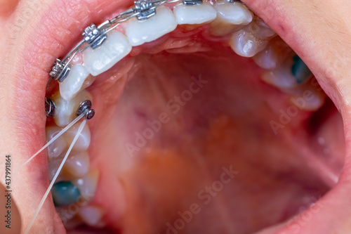 Impacted Cuspid and elastic for correction.