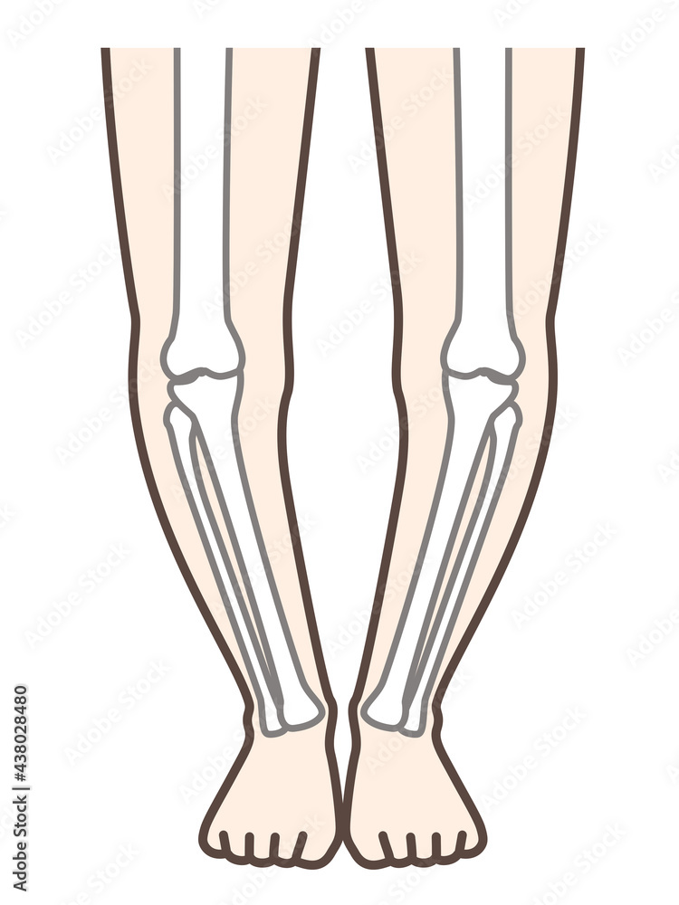 O脚な足 脚 膝の病気の解説用イラスト Stock イラスト Adobe Stock