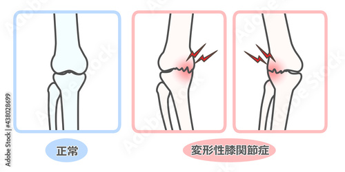 変形性膝関節症 図解