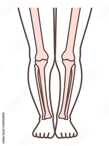 XO脚、膝の病気の解説用イラスト