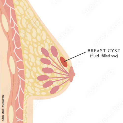 Medical Infographic Cross Section of Female Breast with Cyst. Anatomy of Woman Chest. Mammary gland. Information card with non-cancerous treatable lump. Vector illustration in flat style.