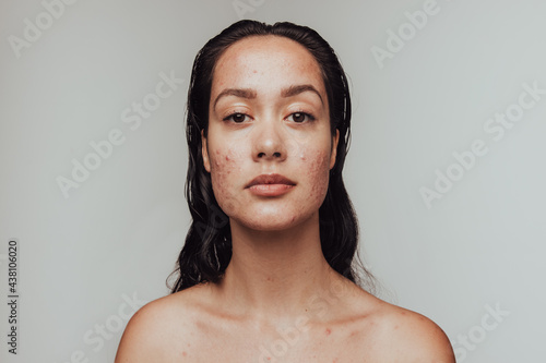 Portrait of woman having skin problems photo