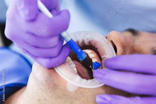 Crop dentist applying fluoride gel on tooth of patient photo