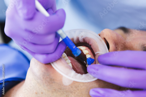 Crop dentist applying fluoride gel on tooth of patient