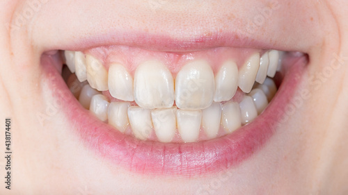 Obraz na plátne Symptoms of demineralization of the teeth
