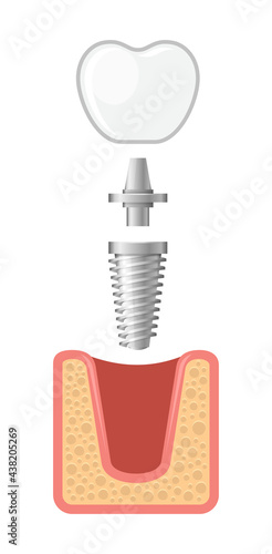 Dental Implant and Human Teeth Set. Vector