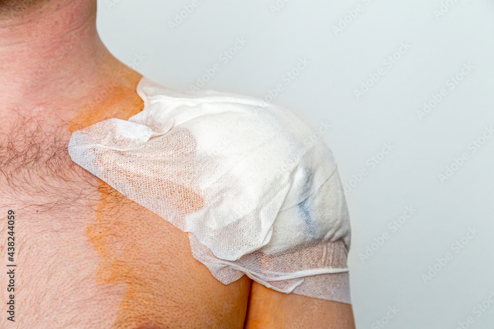 Verband nach einer Schulteroperation, nach einem Unfall