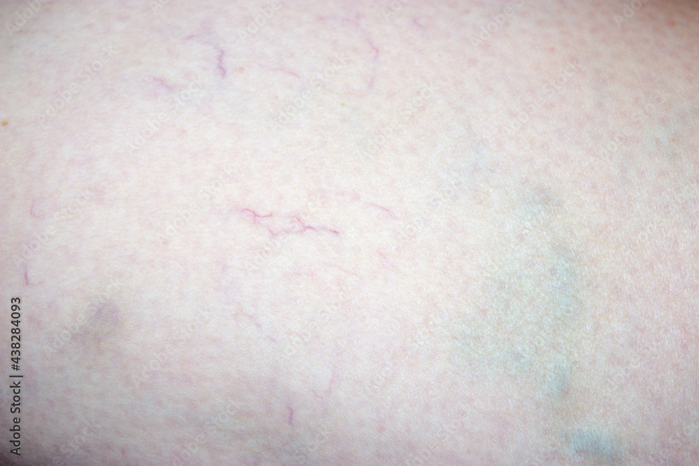 human body sore blood vessels and cuts Stock Photo Adobe Stock