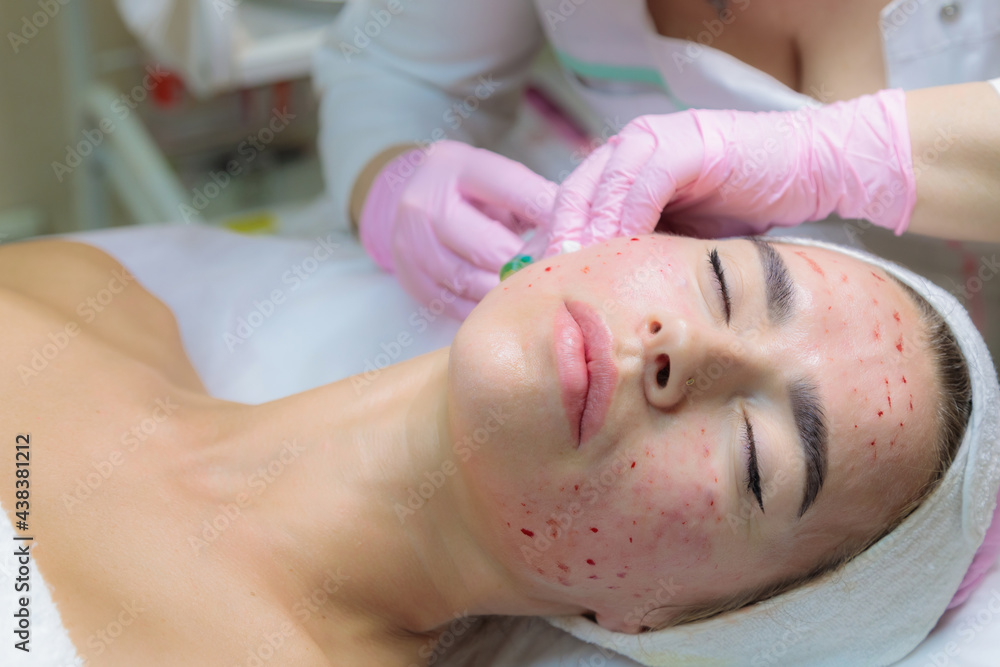 The doctor gives injections of blood plasma into the face of a young girl. The doctor gives injections of blood plasma into the face of a young girl.