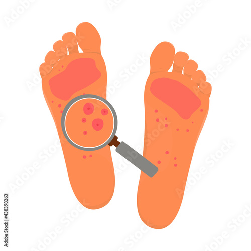 Flat vector cartoon illustration of feet atopic skin and magnifier. Red atopic skin, rashes. White background.
