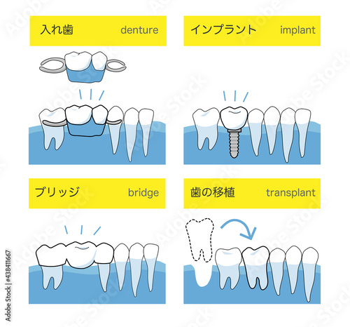 インプラントと入れ歯とブリッジと歯の移植の歯科治療方法の違い