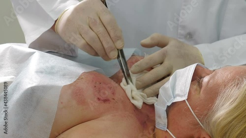 Doctor disinfecting and treating burned skin wound on chest area in emergency. Surgeon team working with burn skin on breast. Medical worker debriding wound with cotton pads wetted with solution. 4 k photo