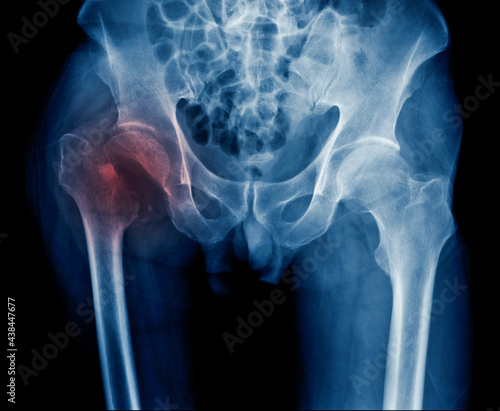 Slika na platnu x-ray hip fracture of old man, x-ray image intertrochanteric fracture
