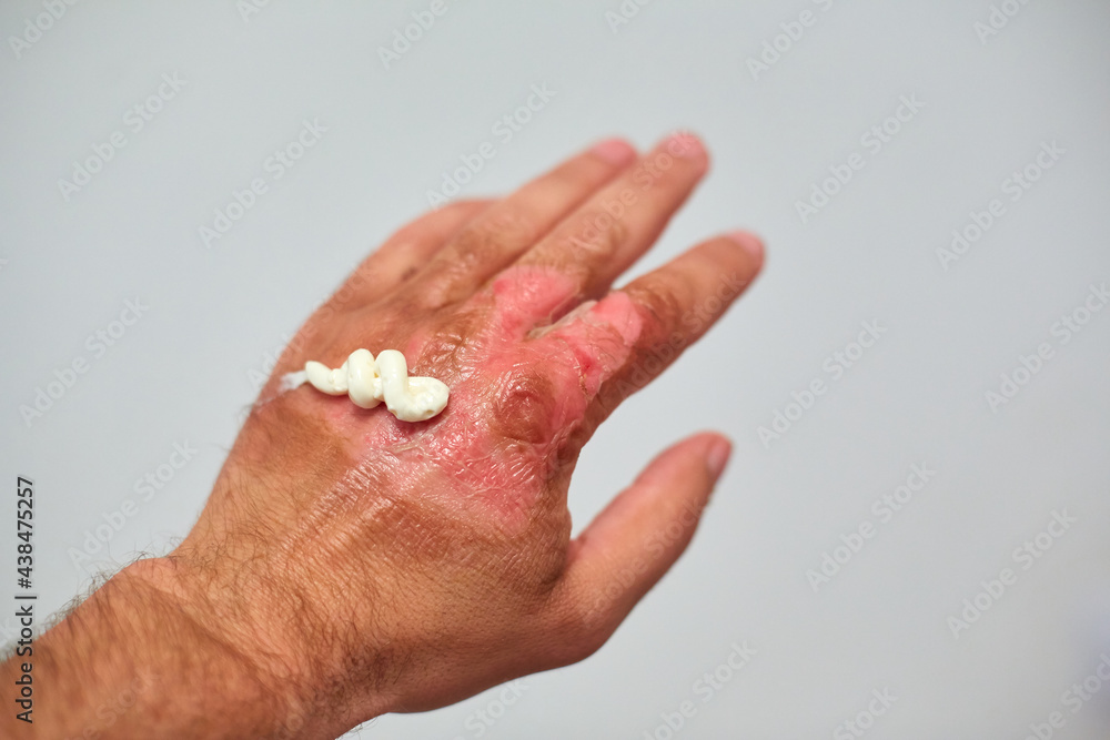 use of healing ointment after burns, first aid for body burns Stock