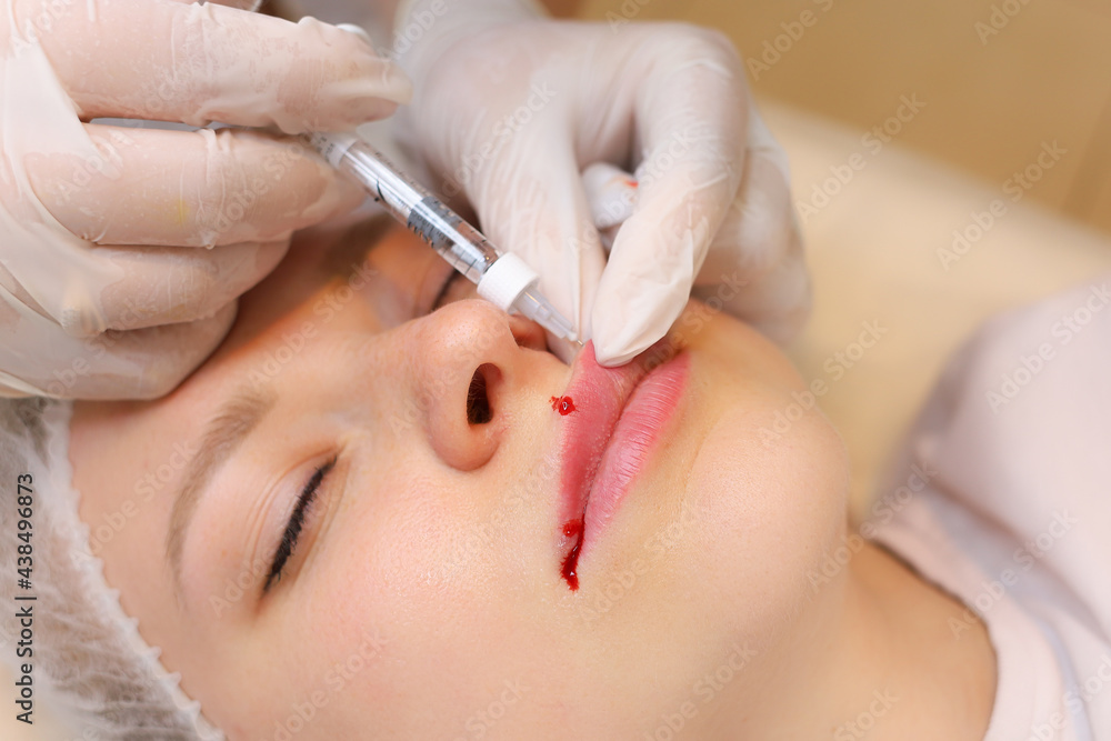 The cosmetologist holds the client's upper lip with two fingers, twisting it to inject hyaluronic acid. Droplets of blood stood out from the previous injection on his lip The cosmetologist holds the client's upper lip with two fingers, twisting it to inject hyaluronic acid. Droplets of blood stood out from the previous injection on his lip